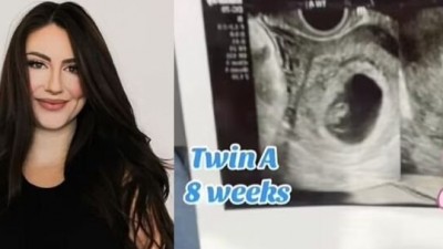 신기하다는 20대녀 중복임신 근황
