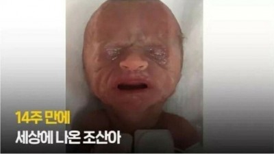  14주 만에 태어난 미숙아의 기적
