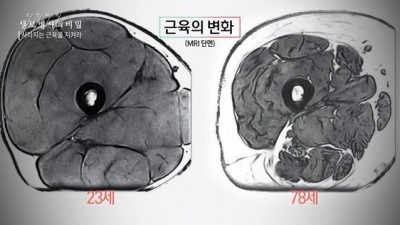  20대와 70대의 허벅지 단면